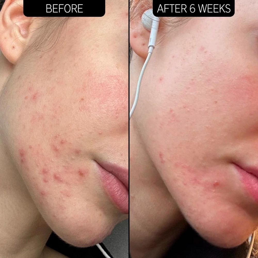 The INKEY List Blemish Clearing Moisturiser 50ml
